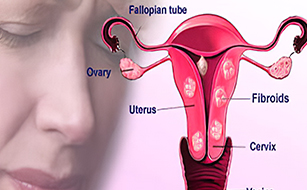Fibroid Uterus